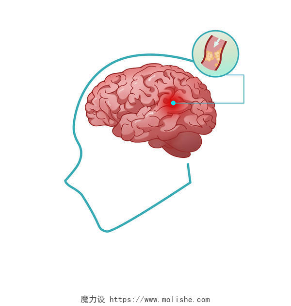 脑卒中示意图 脑卒中 医学人体 PNG素材脑卒中元素